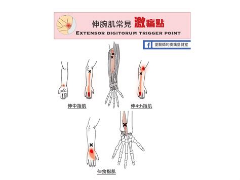 中指受傷|手肘痛、手腕痛、手指痛的原因,治療與自我檢查 » 台。